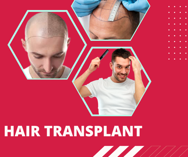 Hair Transplant – Perfect Skin Care